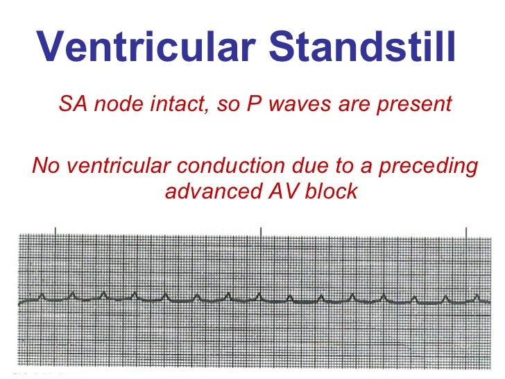 ventricular standstill strips Ventricular standstill strips